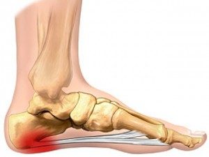 plantar-fasciitis