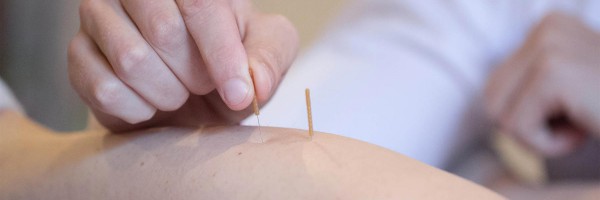 dry-needling-melbourne